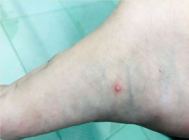 Bóng nước điển hình rải rác các vị trí khác nhau trên cơ thể người bệnh đậu mùa khỉ. 2