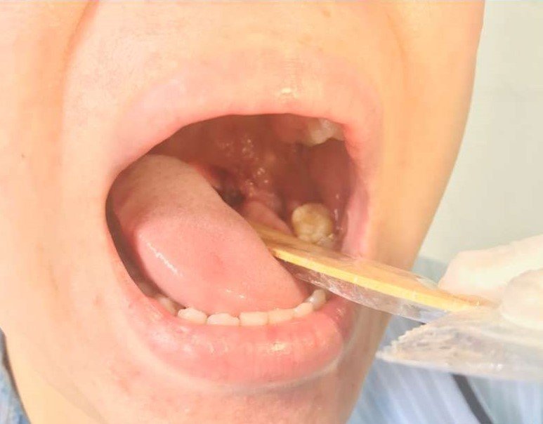 Bóng nước điển hình rải rác các vị trí khác nhau trên cơ thể người bệnh đậu mùa khỉ 1